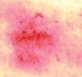 Cambios en la piel sin aplicar crema post-tratamiento tras la estimulación física