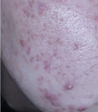 Piel antes de la mejora de imperfecciones inflamatorias