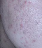 Piel después de la mejora de imperfecciones inflamatorias